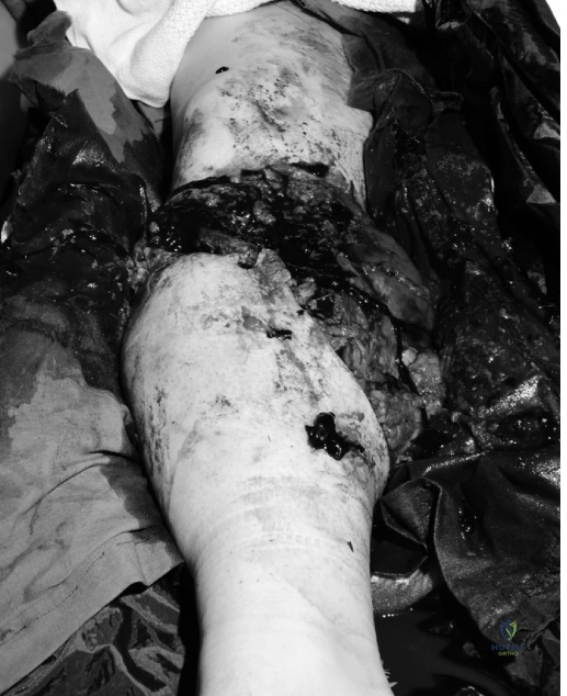 Illustration of mangled extremity trauma - Dr. Mohammed Hutaif