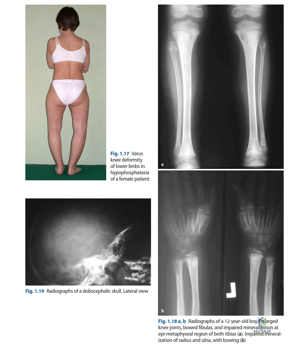 Illustration of orthopedic cases hypophosphatasia - Dr. Mohammed Hutaif