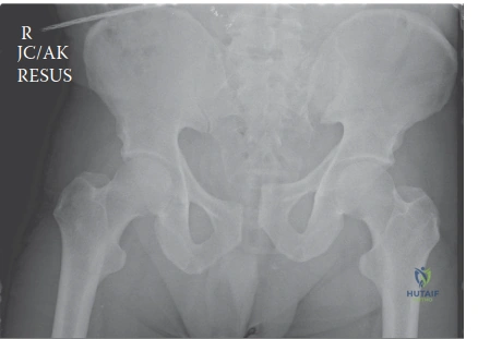 Illustration of fracture case pelvic fracture - Dr. Mohammed Hutaif