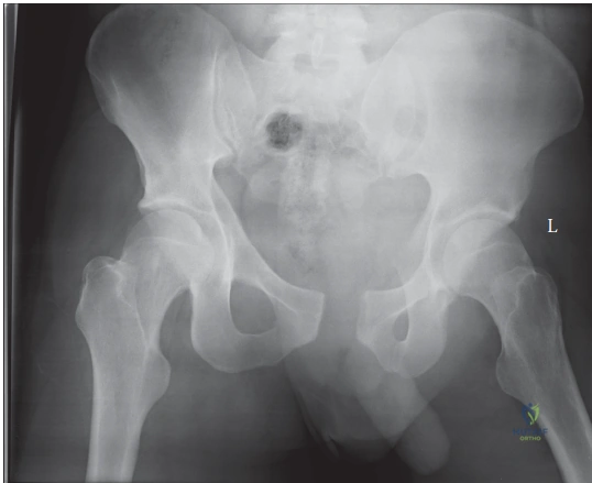 Illustration of pelvic fracture case - Dr. Mohammed Hutaif