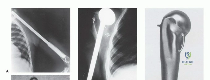 صورة توضيحية لـ استئصال الجزء القريب من عظم العضد بتقنيات الحفاظ على الطرف: دليل شامل للمرضى مع الأستاذ الدكتور محمد هطيف