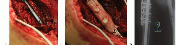 الدليل الشامل لعلاج خلع وكسر مفصل الإصبع وعملية الترميم