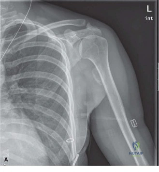 Illustration of orthopedic oncology cases - Dr. Mohammed Hutaif