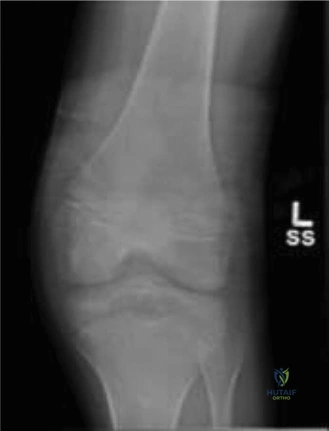 Illustration of tibial eminence fracture - Dr. Mohammed Hutaif