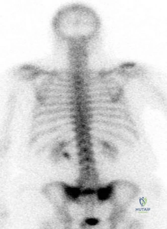 Illustration of sacral insufficiency fractures - Dr. Mohammed Hutaif