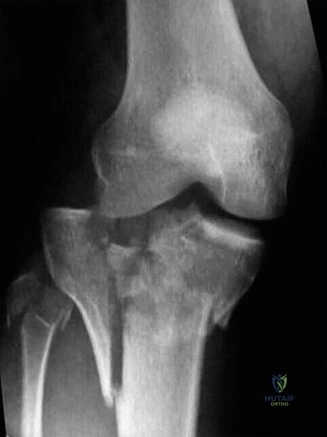 Illustration of case tibial plateau - Dr. Mohammed Hutaif