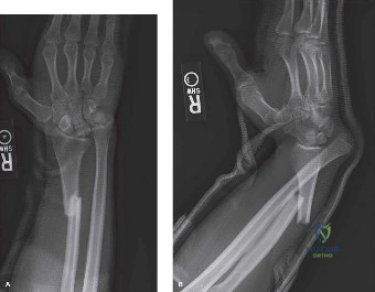 Illustration of radial shaft fracture - Dr. Mohammed Hutaif