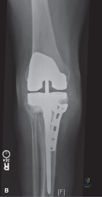 Illustration of painful total knee - Dr. Mohammed Hutaif