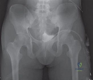 Illustration of traumatic hip dislocations - Dr. Mohammed Hutaif