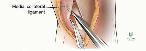 صورة طبية: قطع عظم الظنبوب العالي: إعادة محاذاة الركبة لتخفيف دائم لآلامها مع الأستاذ الدكتور محمد هطيف
