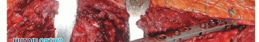 صورة توضيحية لـ إنقاذ الأطراف: أحدث التطورات في استبدال الجزء العلوي من عظم الفخذ