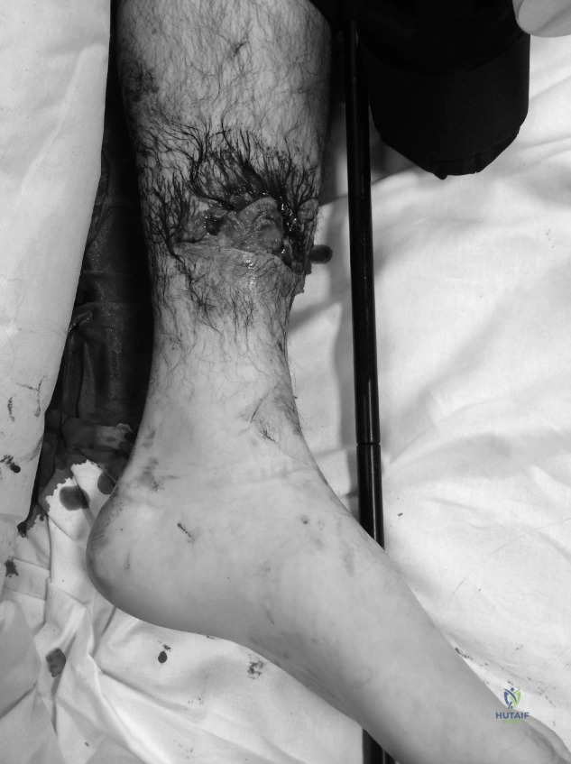 Illustration of midshaft diaphyseal tibia - Dr. Mohammed Hutaif