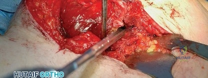 صورة توضيحية لـ النهج الخلفي لمفصل الورك: دليل شامل لاستعادة الحركة في صنعاء مع الأستاذ الدكتور محمد هطيف