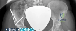 صورة توضيحية لـ قطع العظم حول الحقي بيرنيز: حل دائم لخلل التنسج الوركي واستعادة جودة الحياة