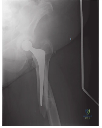 Illustration of periprosthetic fracture periprosthetic - Dr. Mohammed Hutaif