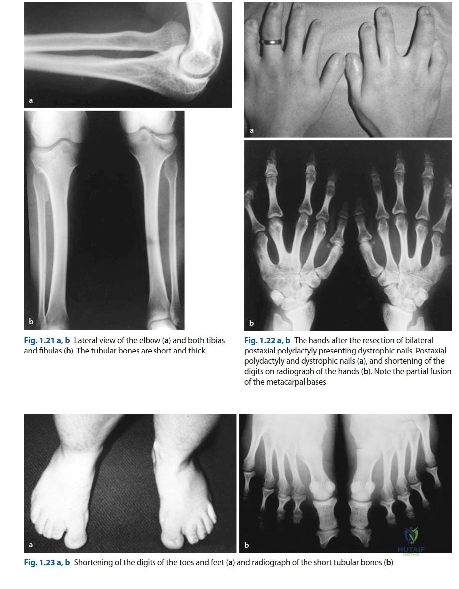 Illustration of ellisvan crevelds syndrome - Dr. Mohammed Hutaif
