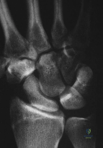 Illustration of degrees elbow flexed - Dr. Mohammed Hutaif