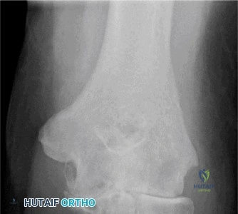 صورة توضيحية لـ خشونة مفصل الكوع (المرفق): دليلك الشامل للأسباب، الأعراض، والخيارات العلاجية في صنعاء مع الأستاذ الدكتور محمد هطيف