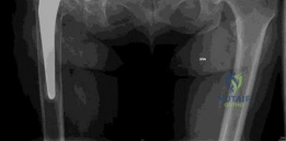 Illustration of case title acetabular - Dr. Mohammed Hutaif