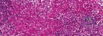 صورة توضيحية لـ الورم الحبيبي لم الخلايا لانغرهانس العظمي: دليل شامل للمرضى مع الأستاذ الدكتور محمد هطيف
