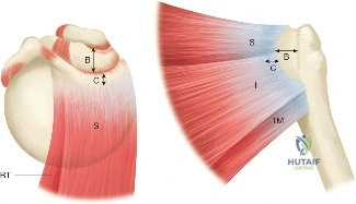 Unraveling Infraspinatus and Teres Rotator Cuff Tears