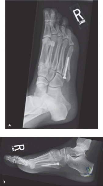 Illustration of fifth metatarsal fractures - Dr. Mohammed Hutaif
