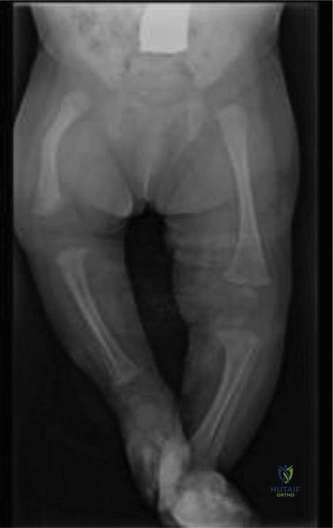 Pediatric Salter-Harris Type IV Distal Femoral Physeal Fracture: A Case Study