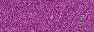 Illustration of oncology cases myeloma - Dr. Mohammed Hutaif