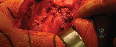 صورة طبية: المدخل الخلفي الجانبي لجراحة استبدال مفصل الورك الكلي: دليل شامل للمرضى في صنعاء مع الأستاذ الدكتور محمد هطيف