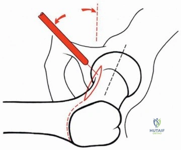 صورة طبية: قطع العظم المدوري الانزلاقي: دور حديث وتقنيات متطورة لاستعادة حركة الورك