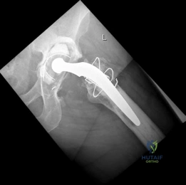 صورة شعاعية أمامية خلفية للحوض توضح مفصل ورك صناعي مثبت بالأسمنت مع انحراف رأس عظم الفخذ داخل البطانة البولي إيثيلين.