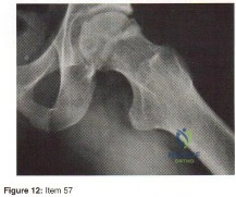 OITE & ABOS Orthopedic Board Prep: Practice Exam Part 166