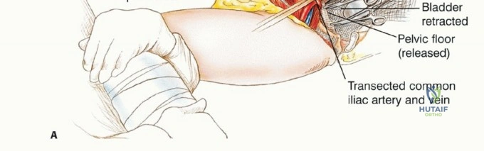 صورة طبية: استئصال نصف الحوض بالرفرفة الخلفية: دليل شامل للمرضى مع الأستاذ الدكتور محمد هطيف