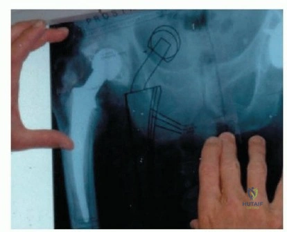 صورة توضيحية لـ جراحة إعادة زرع مفصل الورك الحل النهائي للمفاصل الصناعية الملتهبة في صنعاء مع الأستاذ الدكتور محمد هطيف