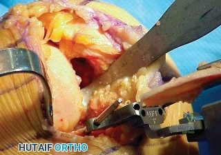 صورة توضيحية لـ تقويم مفصل الركبة أحادي الحجرة دليل شامل للمرضى في صنعاء