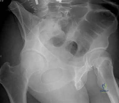 صورة طبية: دليل شامل لكسور وإصابات الجهاز الحركي: رعاية متقدمة في صنعاء مع الأستاذ الدكتور محمد هطيف