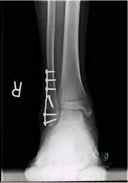 صورة طبية: دليل شامل لكسور وإصابات الجهاز الحركي: رعاية متقدمة في صنعاء مع الأستاذ الدكتور محمد هطيف
