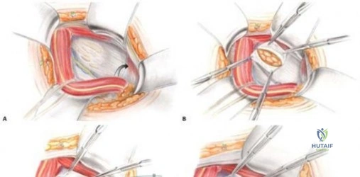 صورة طبية: فهم آلام العانة وإصابات العضلات المقربة: دليلك الشامل للتشخيص والعلاج مع الأستاذ الدكتور محمد هطيف