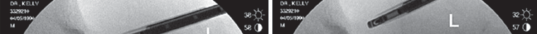 صورة طبية: حل ألم الورك المستمر: استئصال الورم العظمي العظمي بالمنظار مع الأستاذ الدكتور محمد هطيف في صنعاء