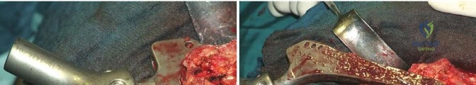 صورة طبية: جراحة استبدال مفصل الورك الملتهب في مرحلة واحدة: حل فعال وشامل مع الأستاذ الدكتور محمد هطيف