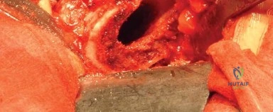 صورة طبية: المدخل الخلفي الجانبي لجراحة استبدال مفصل الورك الكلي: دليل شامل للمرضى في صنعاء مع الأستاذ الدكتور محمد هطيف