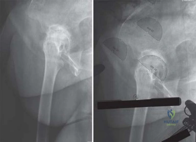 الكتف المتجمد- التشخيص- فحص الطبيب
