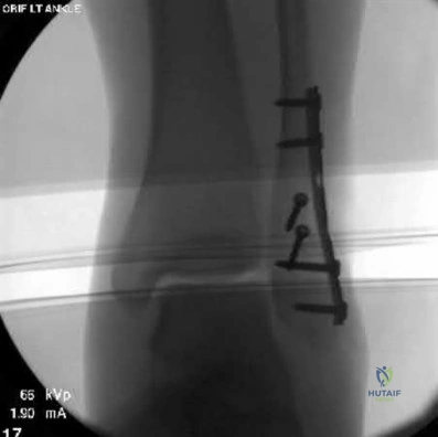 صورة طبية: دليل شامل لكسور وإصابات الجهاز الحركي: رعاية متقدمة في صنعاء مع الأستاذ الدكتور محمد هطيف