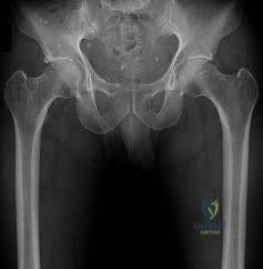 صورة توضيحية لـ إصابات الملاعب وجراحة العظام: دليل شامل من الأستاذ الدكتور محمد هطيف في صنعاء