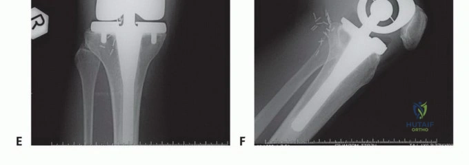 صورة طبية: النقائل العظمية الفخذية: دليل شامل للعلاج واستعادة الوظيفة مع الأستاذ الدكتور محمد هطيف في صنعاء