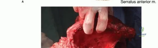 مريض يتدرب على استخدام الطرف الصناعي