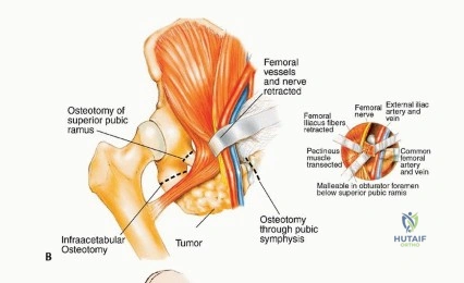 Illustration of gluteus maximus muscle - Dr. Mohammed Hutaif