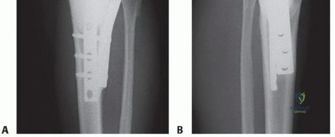 صورة طبية: تجنب الجراحة الكبرى: علاج أورام العظام بالنيتروجين السائل بتقنية الصب المباشر