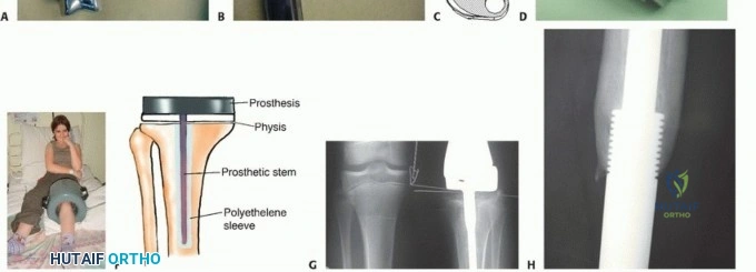 صورة توضيحية لـ الأطراف الصناعية القابلة للتمدد للأطفال: دليل شامل للمرضى حول الوقاية من العدوى والعلاج في صنعاء مع الأستاذ الدكتور محمد هطيف