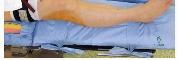صورة توضيحية لـ قطع عظم الظنبوب العالي: إعادة محاذاة الركبة لتخفيف دائم لآلامها مع الأستاذ الدكتور محمد هطيف